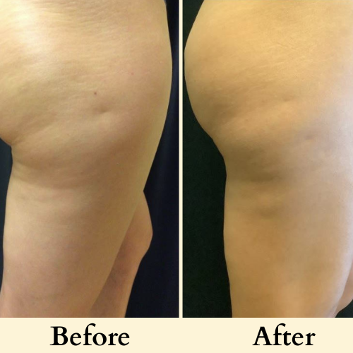Elure. Anti Cellulite Massage Oil